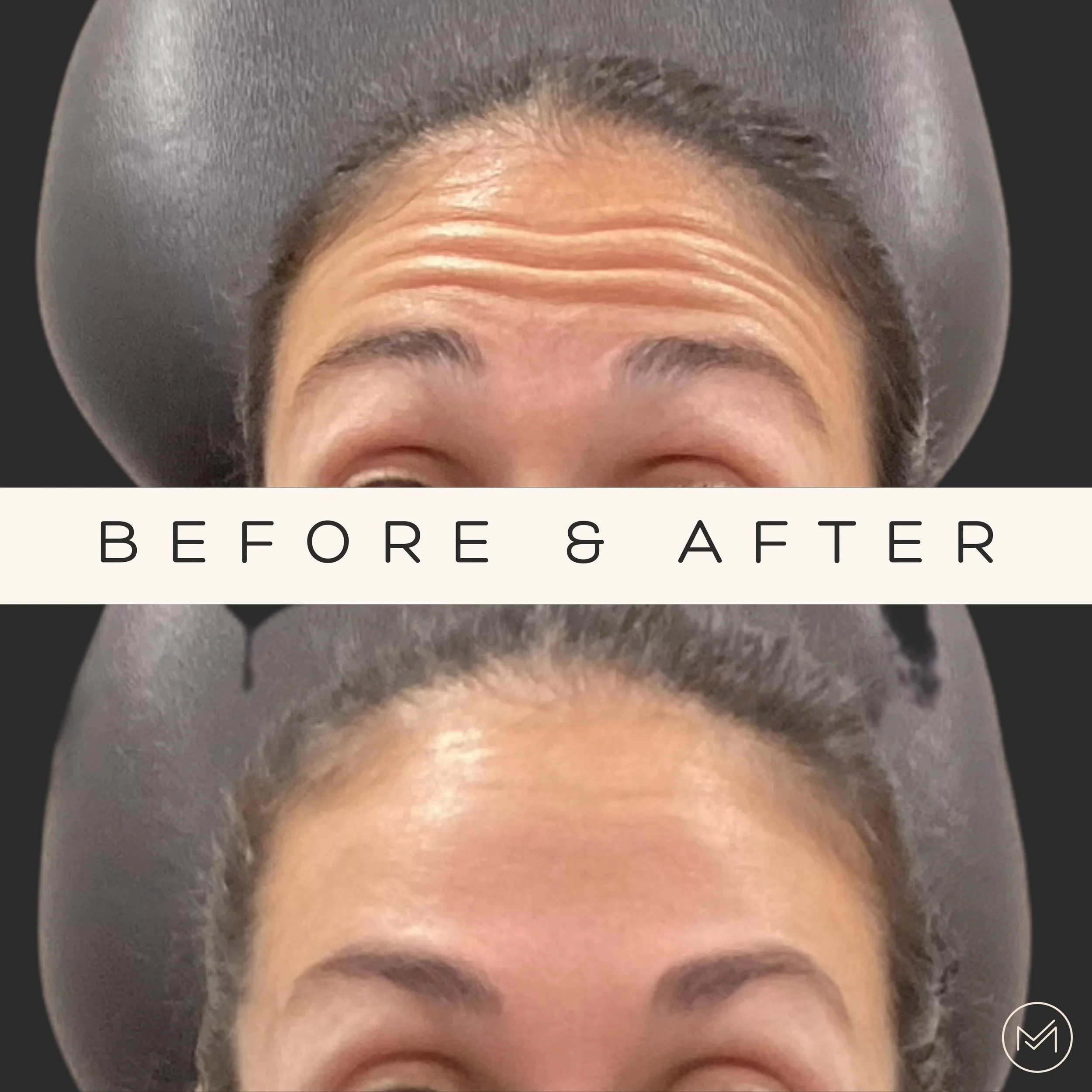 Botox Transform Your Look with Botox at Morph Med Spa in Ridgefield